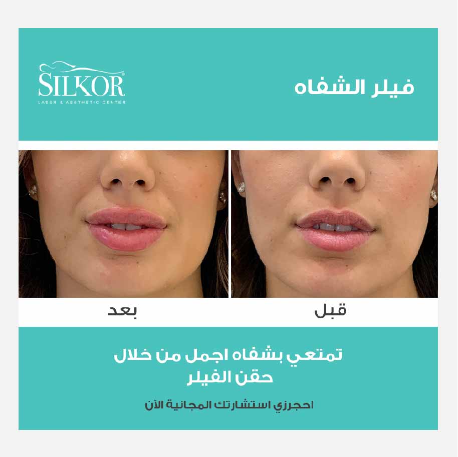 Silkor - laser center - beauty clinc - cosmetic clinc - free consultation - lip fillers - botox lips - dermal fillers - dubai