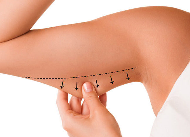 Liposuction to remove fat from upper arms.