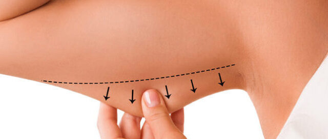 Liposuction to remove fat from upper arms.