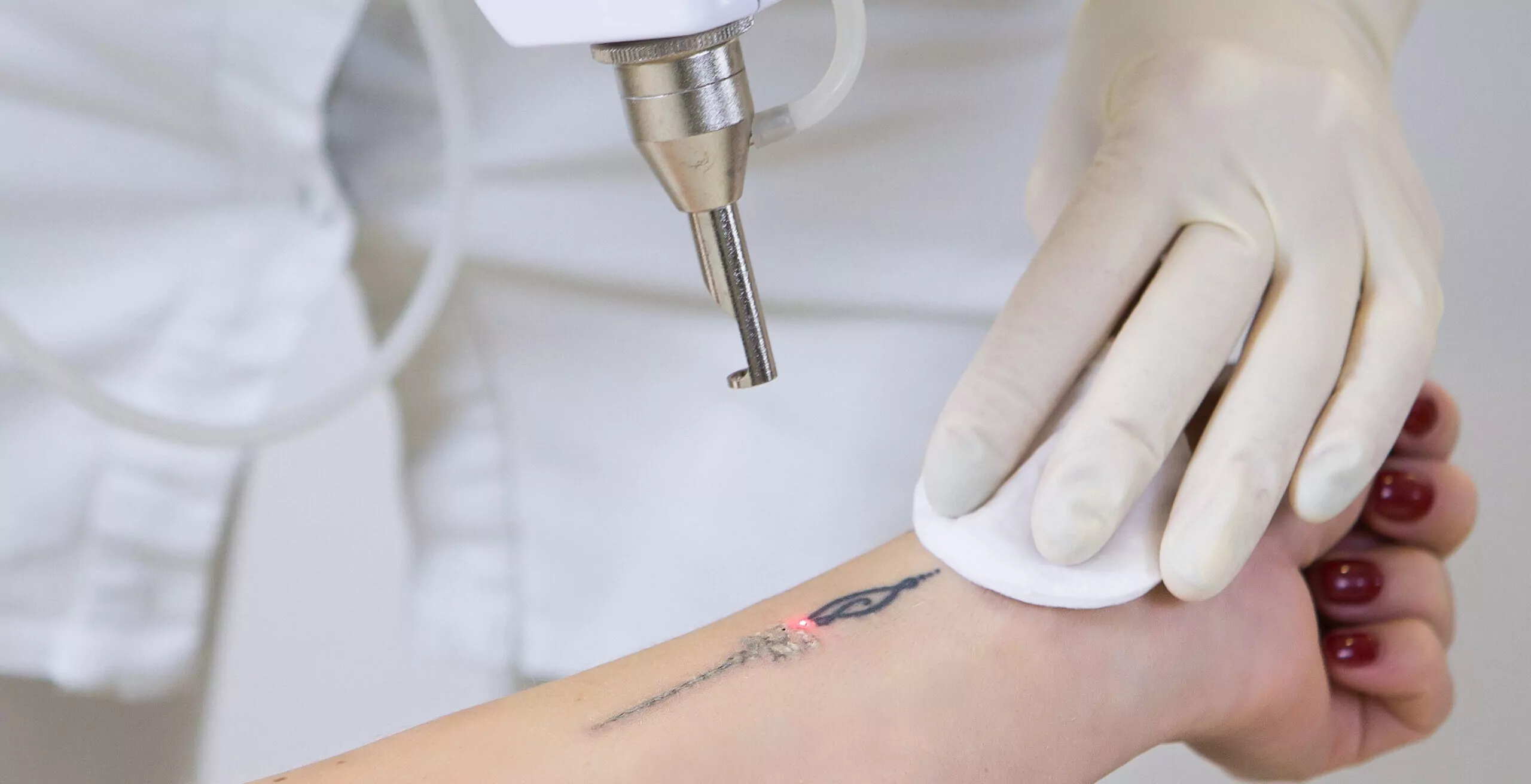 Laser Tattoo Removal /Tattoo pigment reduction. 