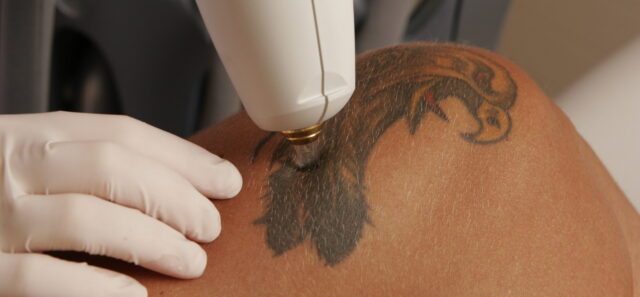 Tattoo Removal