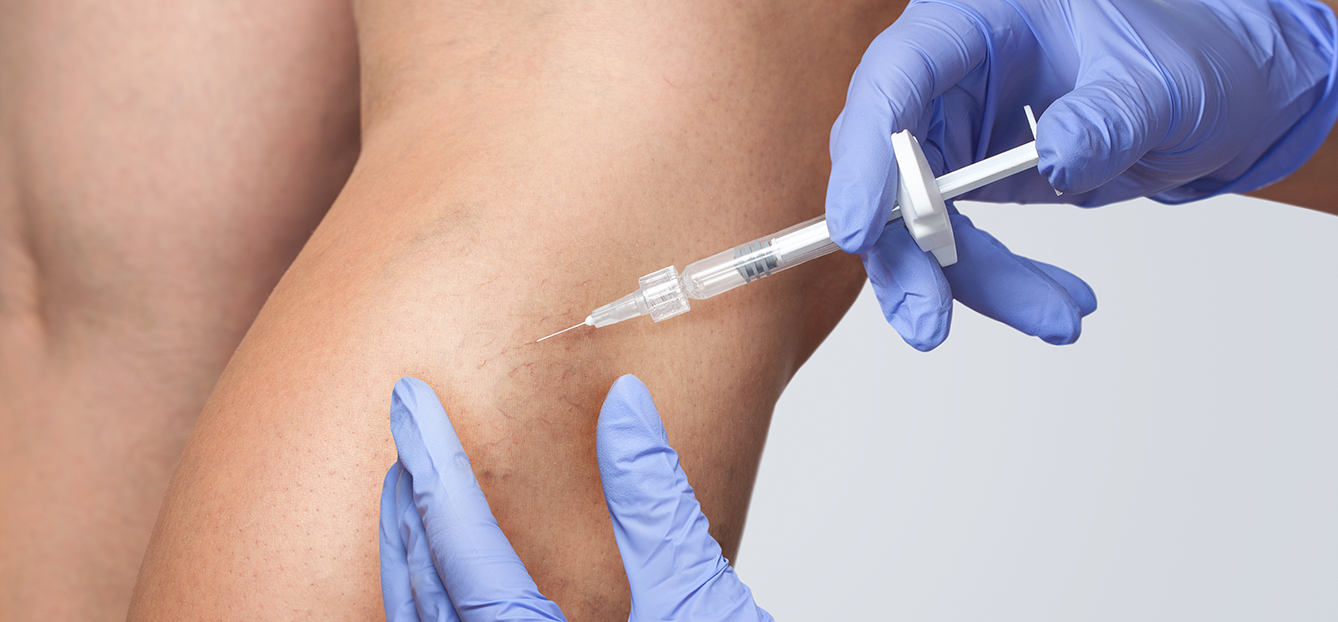 Sclerotherapy Treatment