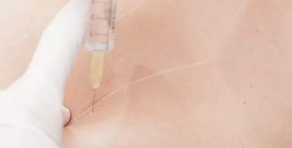 Mesotherapy Fat Reduction