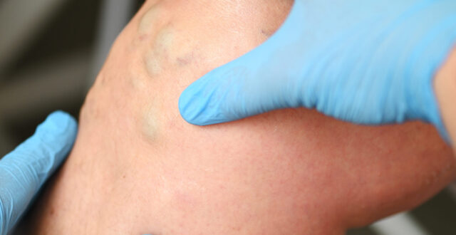 Varicose Veins