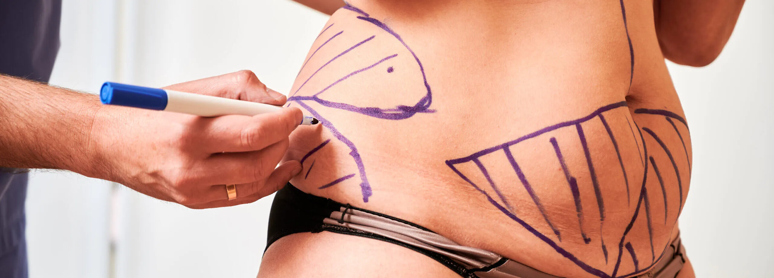 From Loose Skin to Smooth Curves: What a Body Lift Can Do