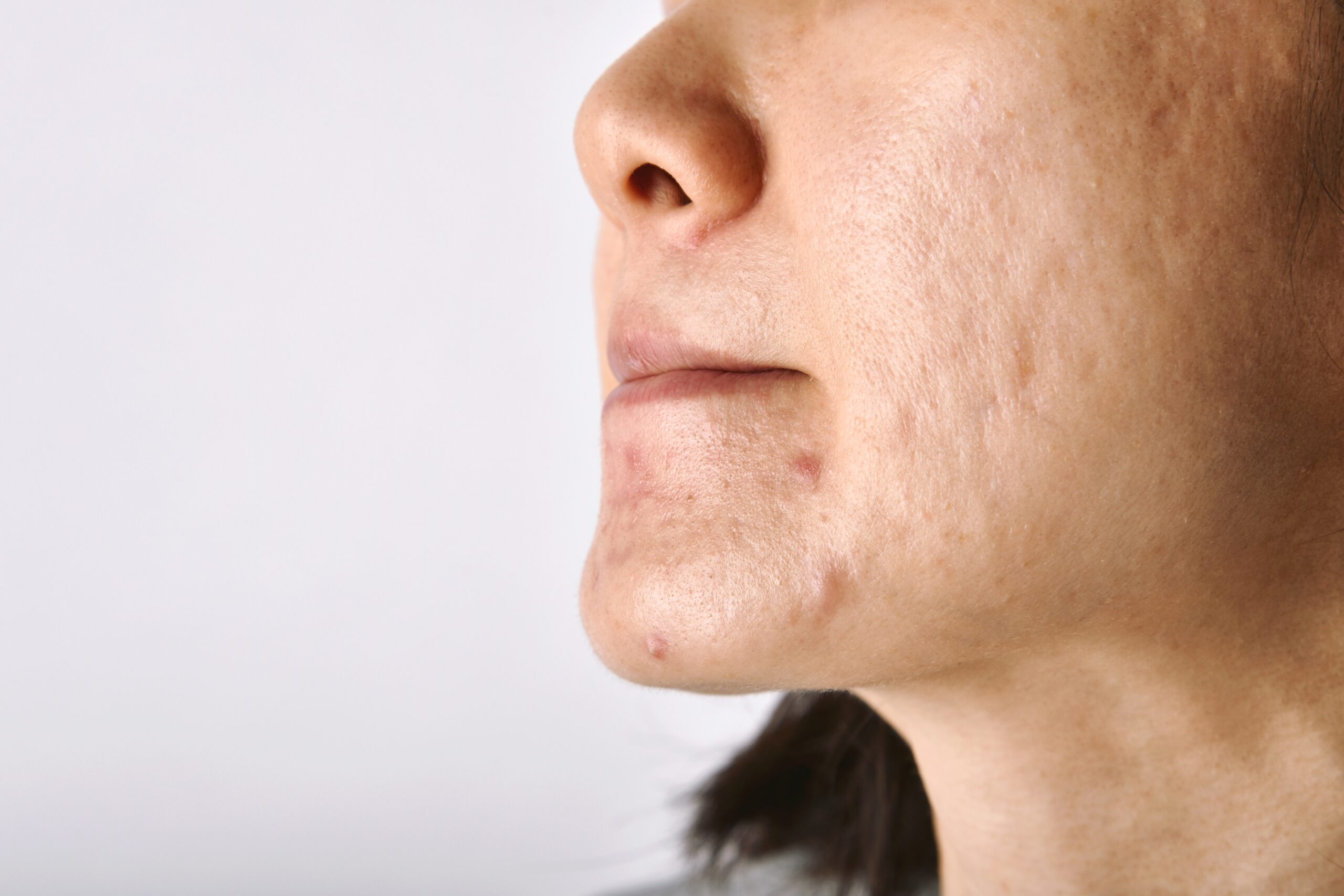 Acne Scarring 