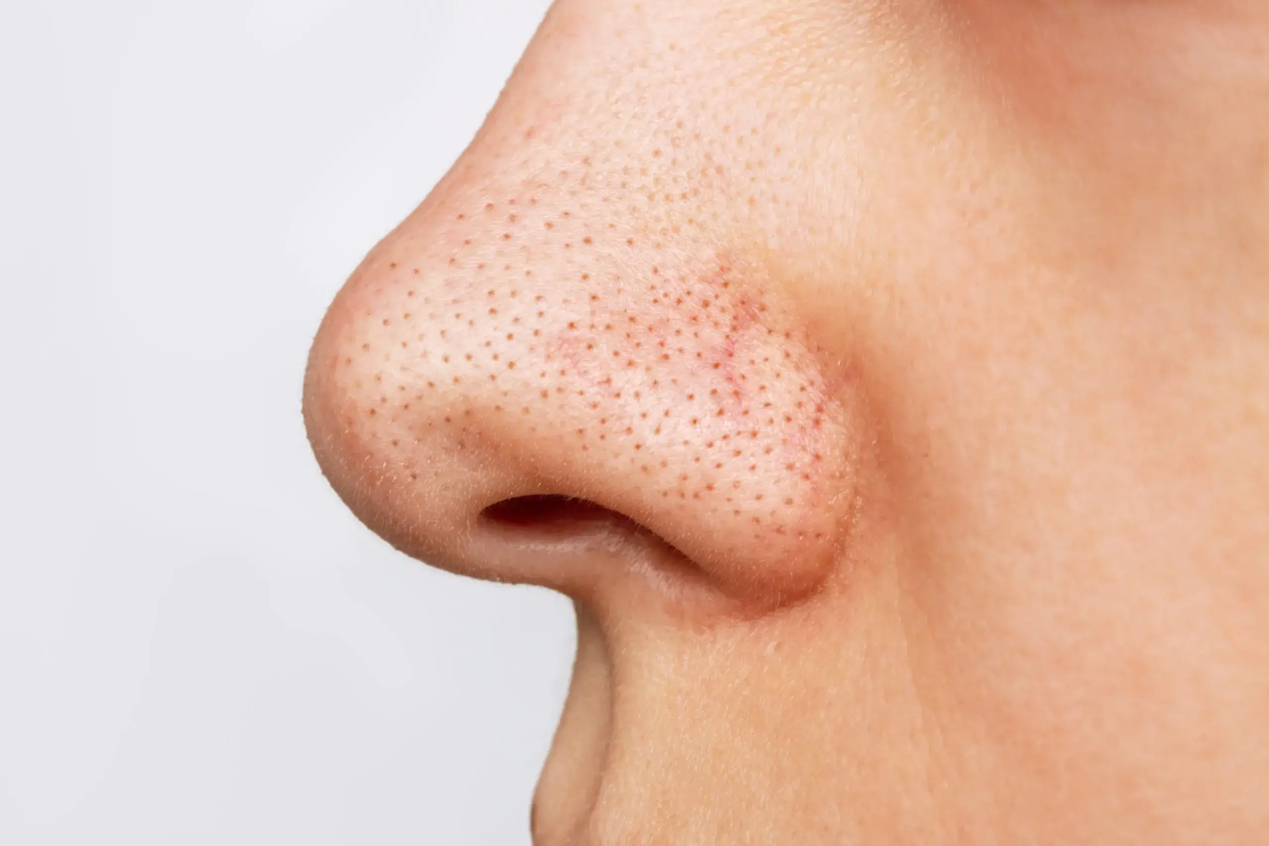 Get Rid of Blackheads Permanently