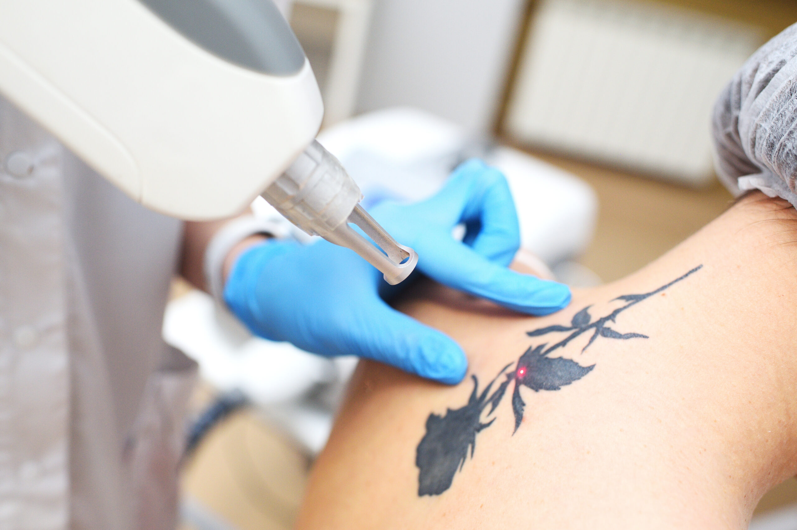 Safe and Effective Tattoo Removal
