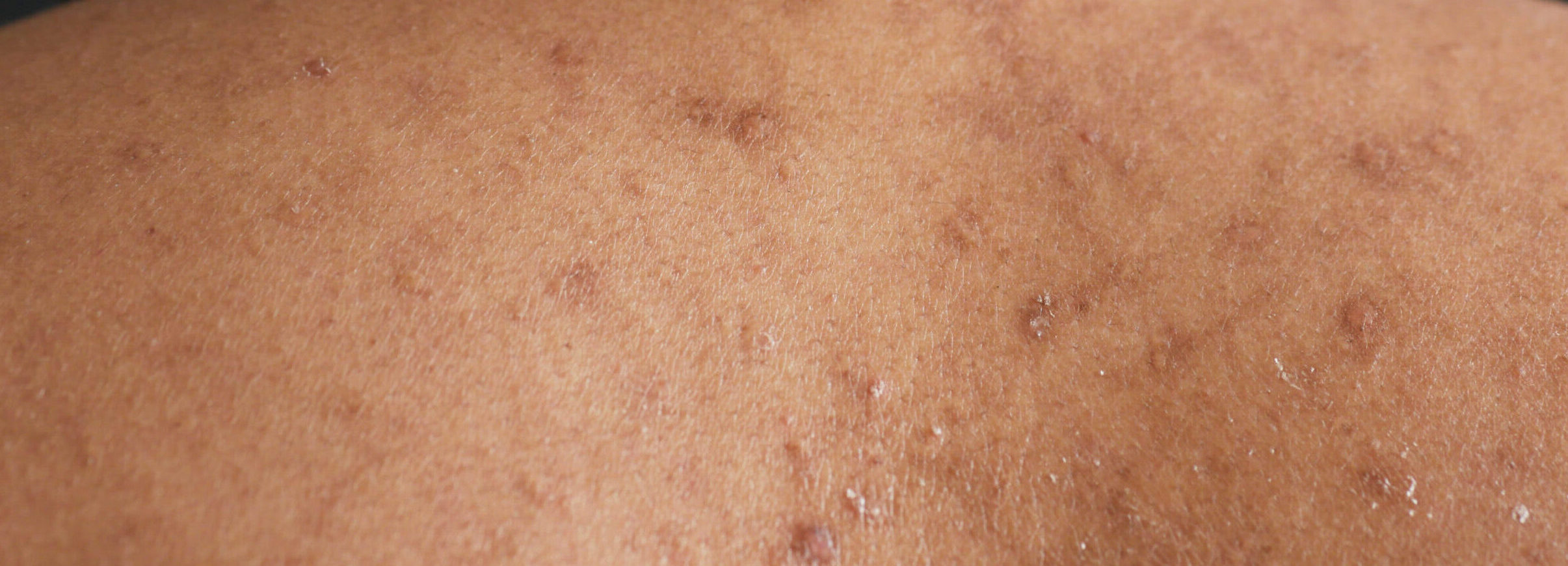 Back acne