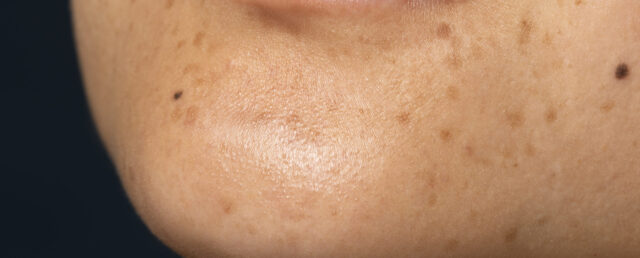 Skin Spots