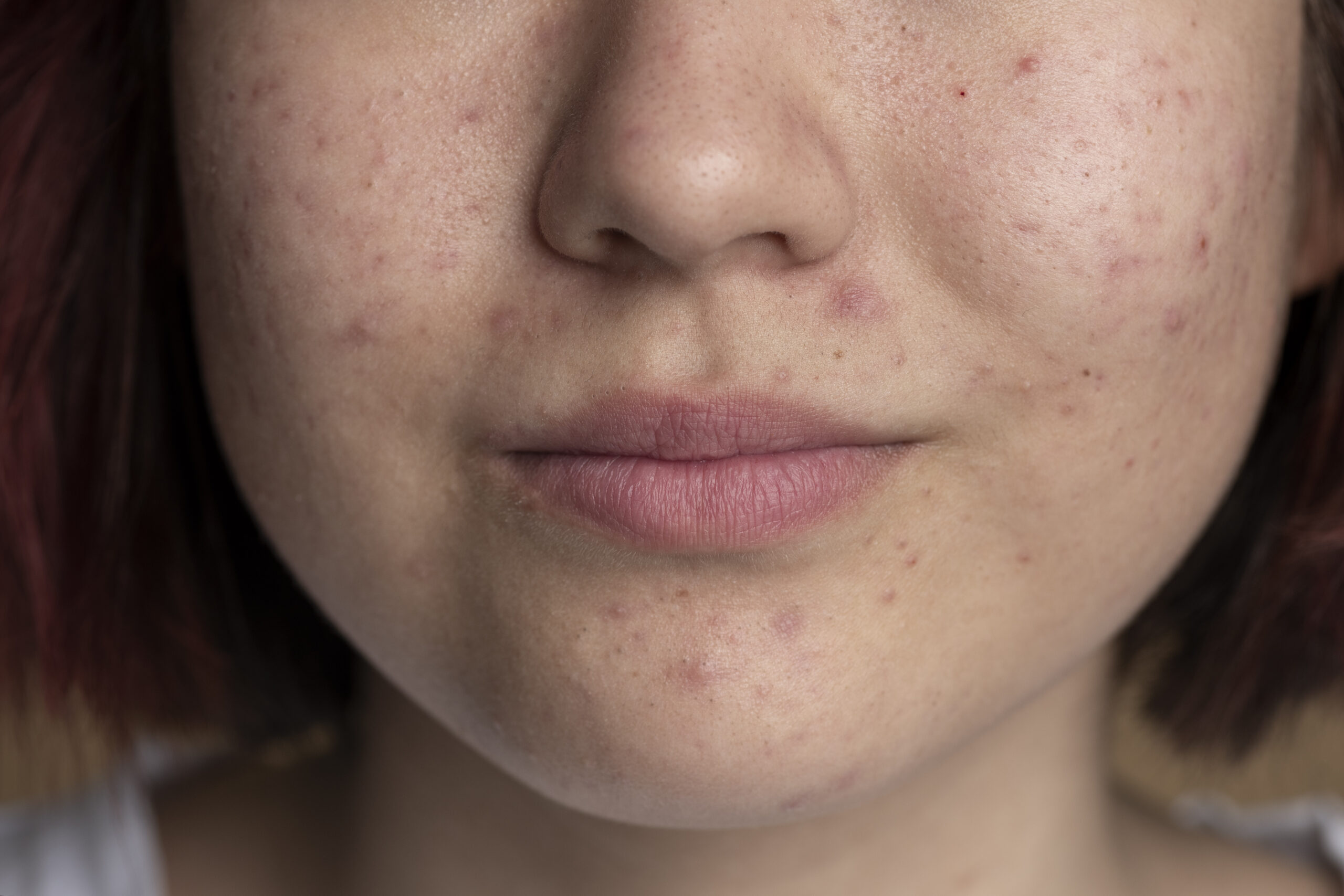 المضادات الحيوية لحب الشباب: دليلك الشامل لنتائج فعالة وآمنة