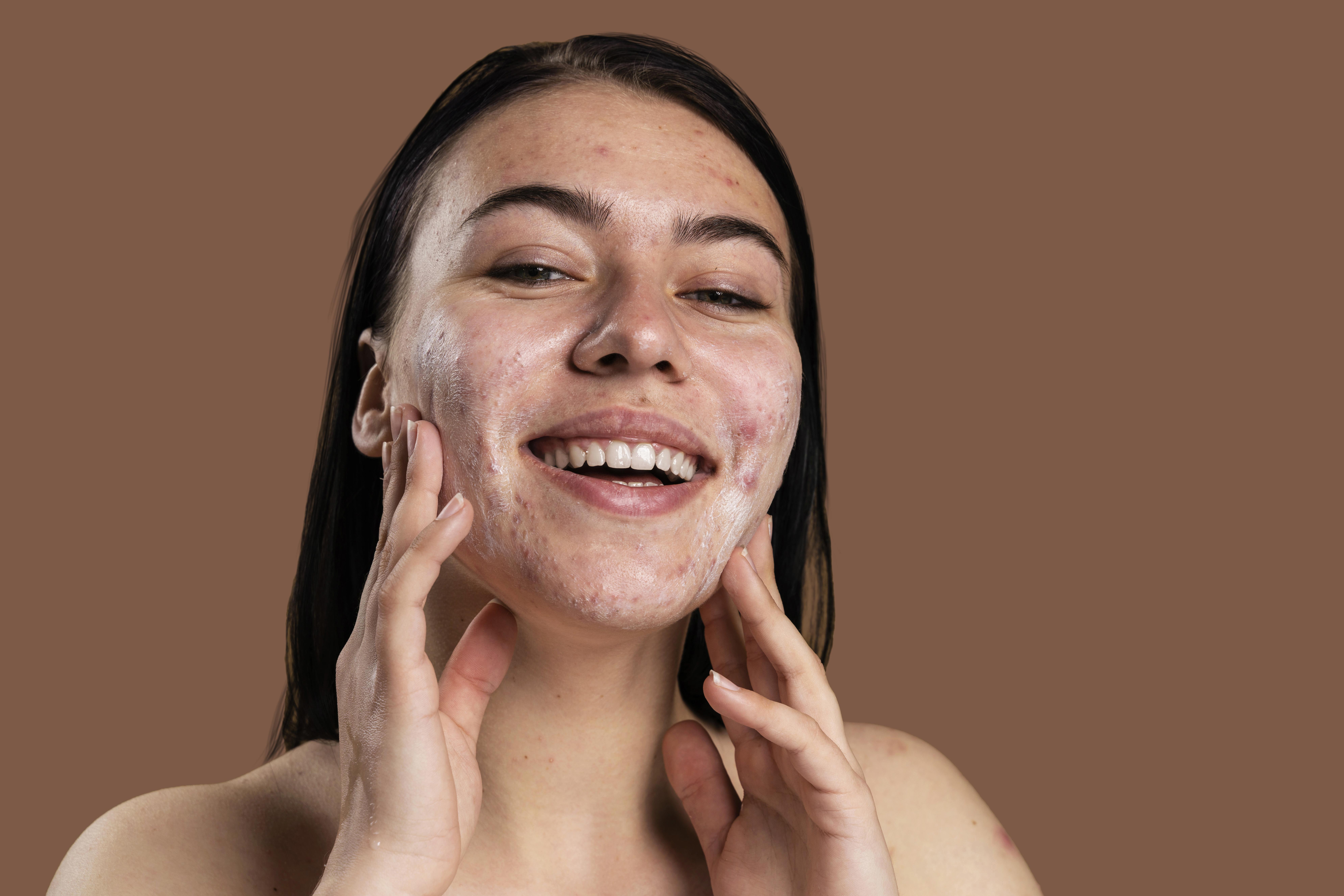 كل ما تحتاج معرفته عن حب الشباب الهرموني وطرق علاجه بفعالية