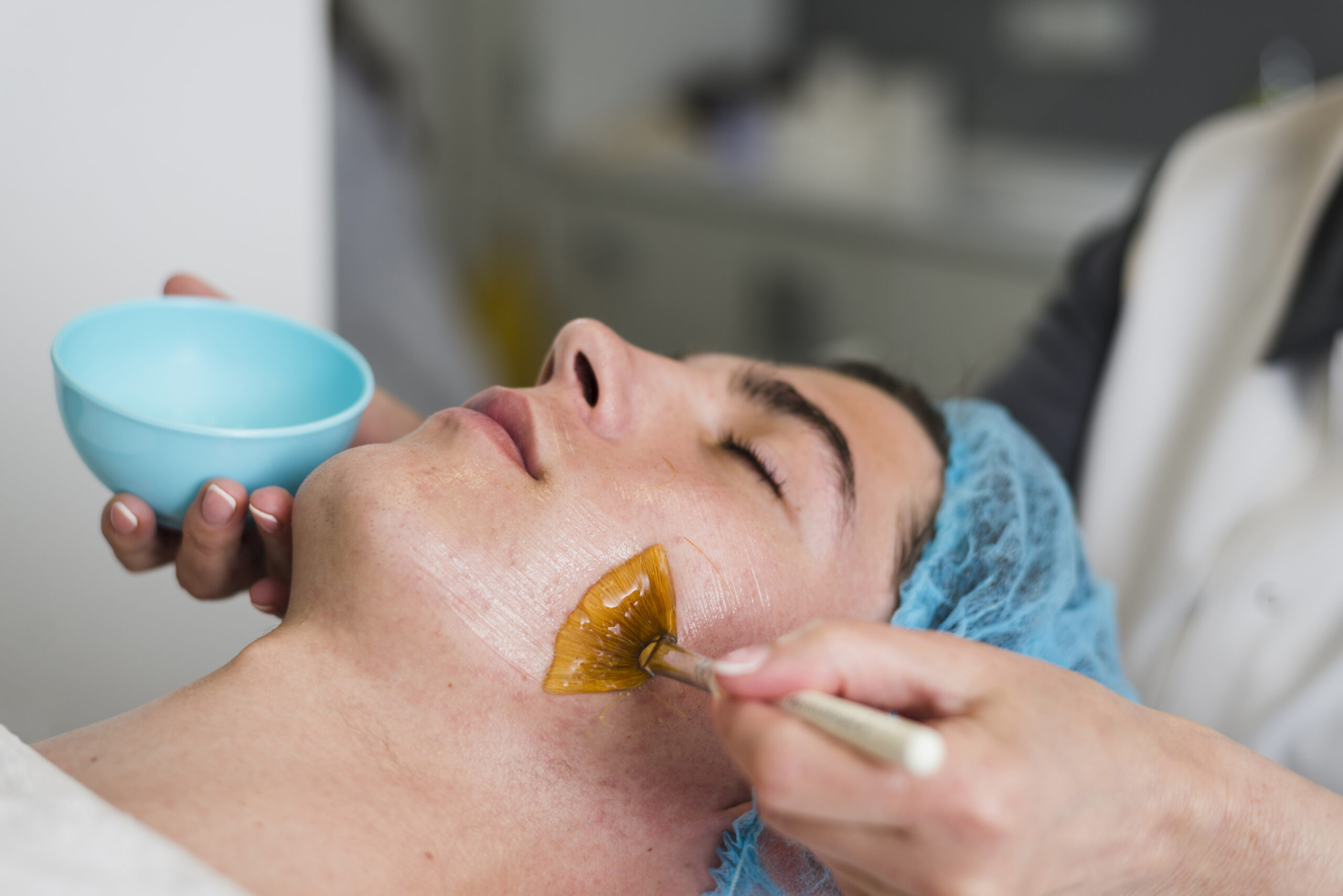 Chemical Peels: Safe & Effective Treatment For Stubborn Dark Spots 