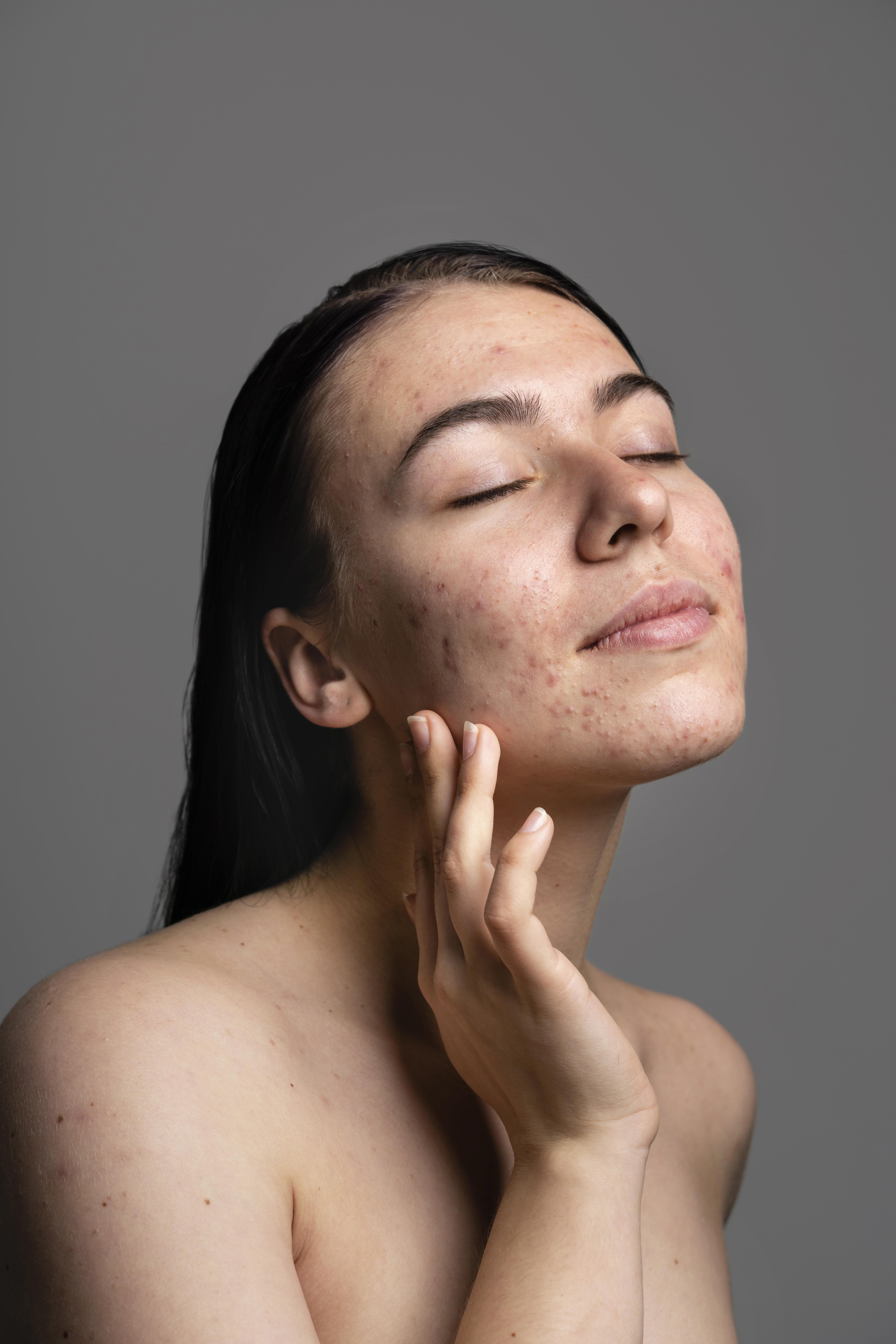 Hormonal Acne: Here's All You Need To Know To Treat It Effectively