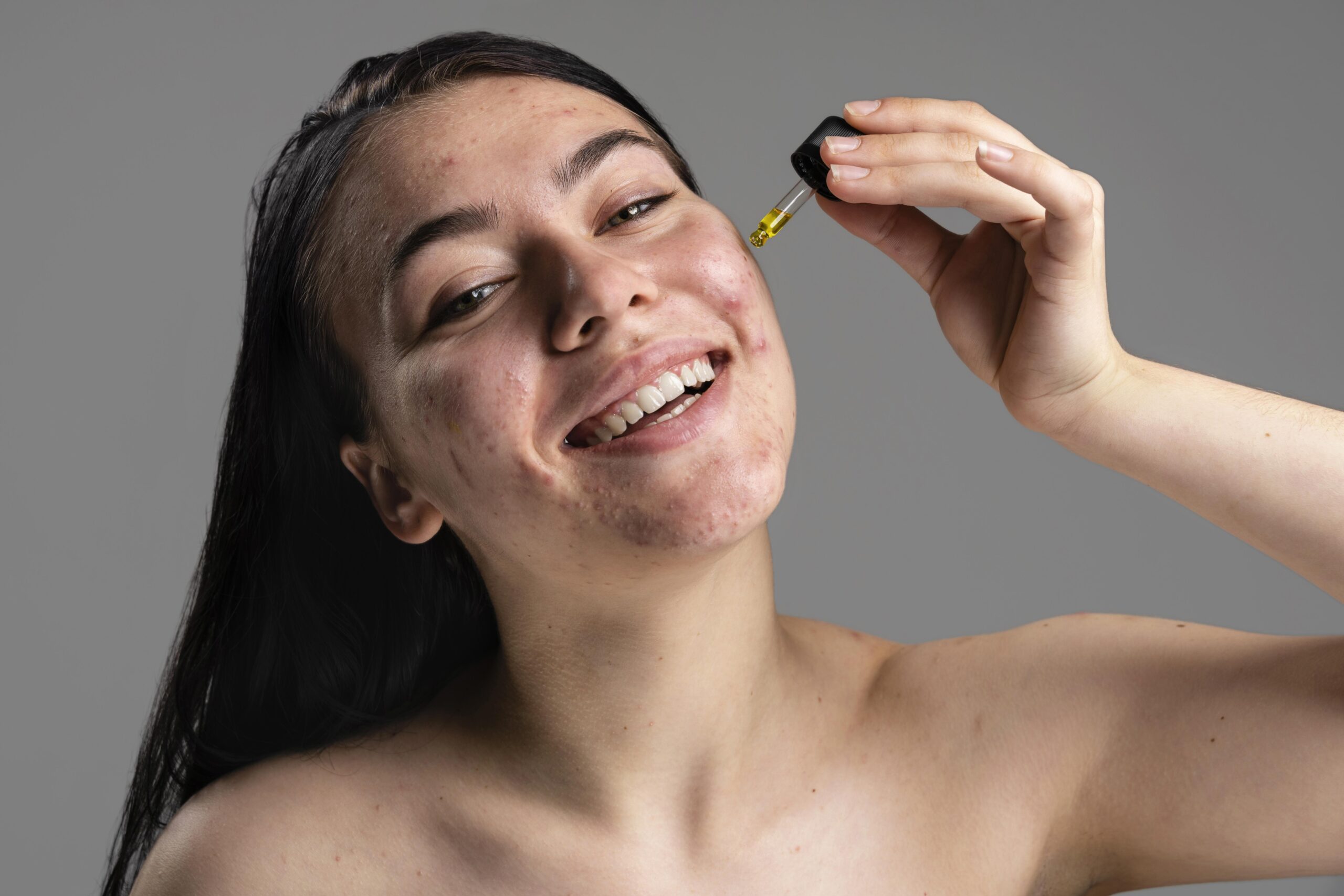 How to Get Rid of Pimples Overnight