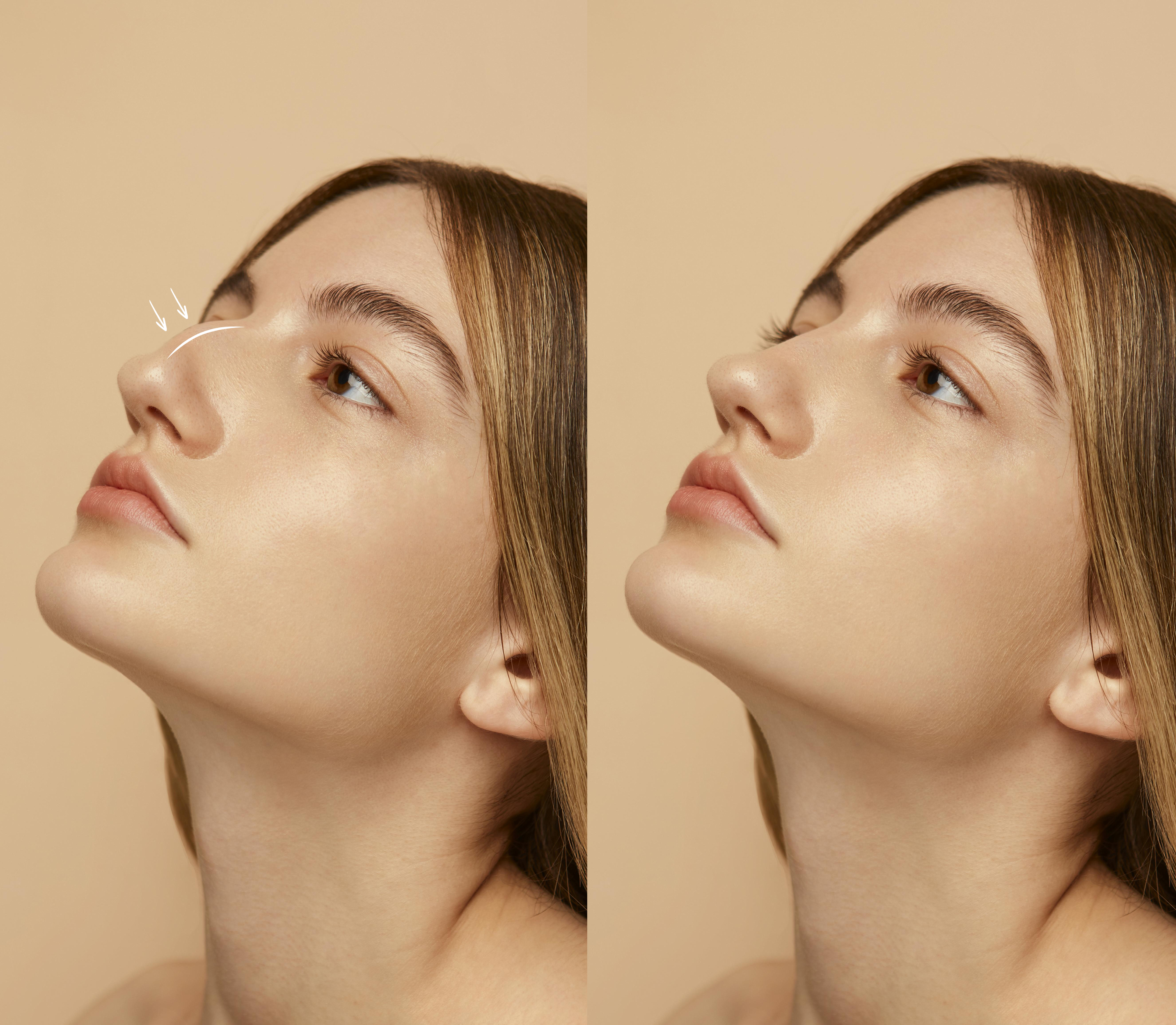 Here's What You Need To Know About Rhinoplasty Scars