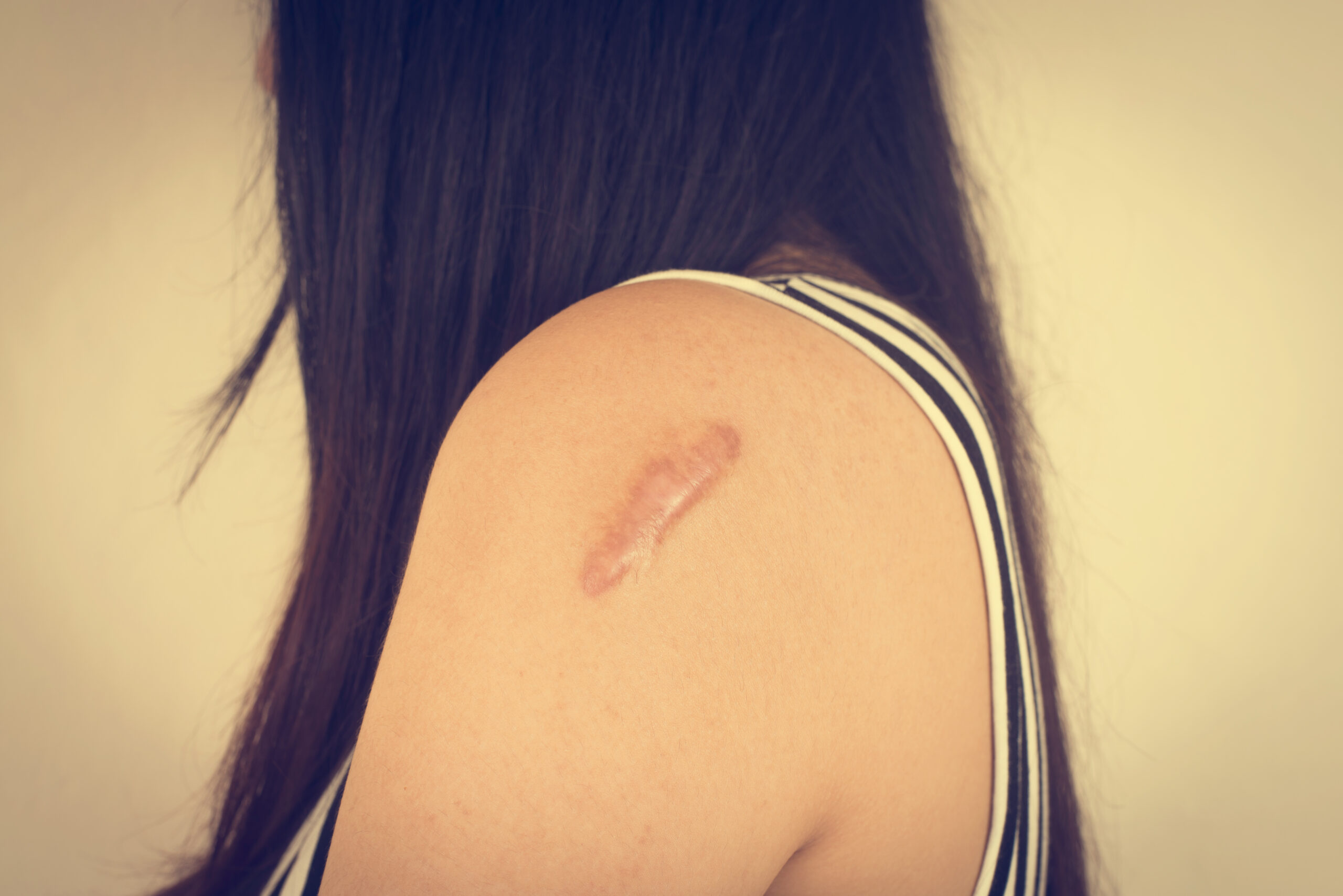 How to Reduce Wound Marks: Simple Steps for Better Skin