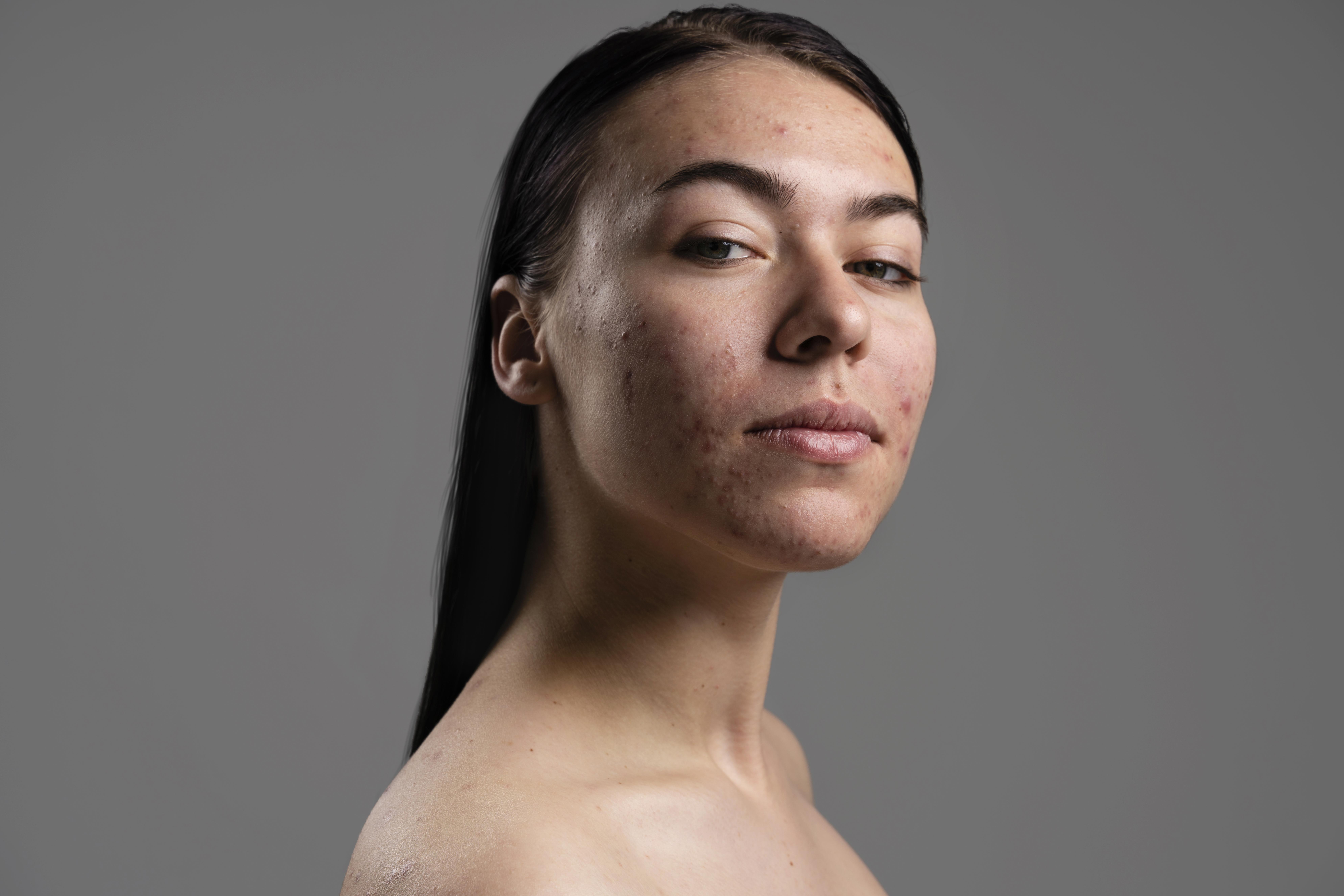 We Tried Everything for Acne, Until Laser Entered the Chat