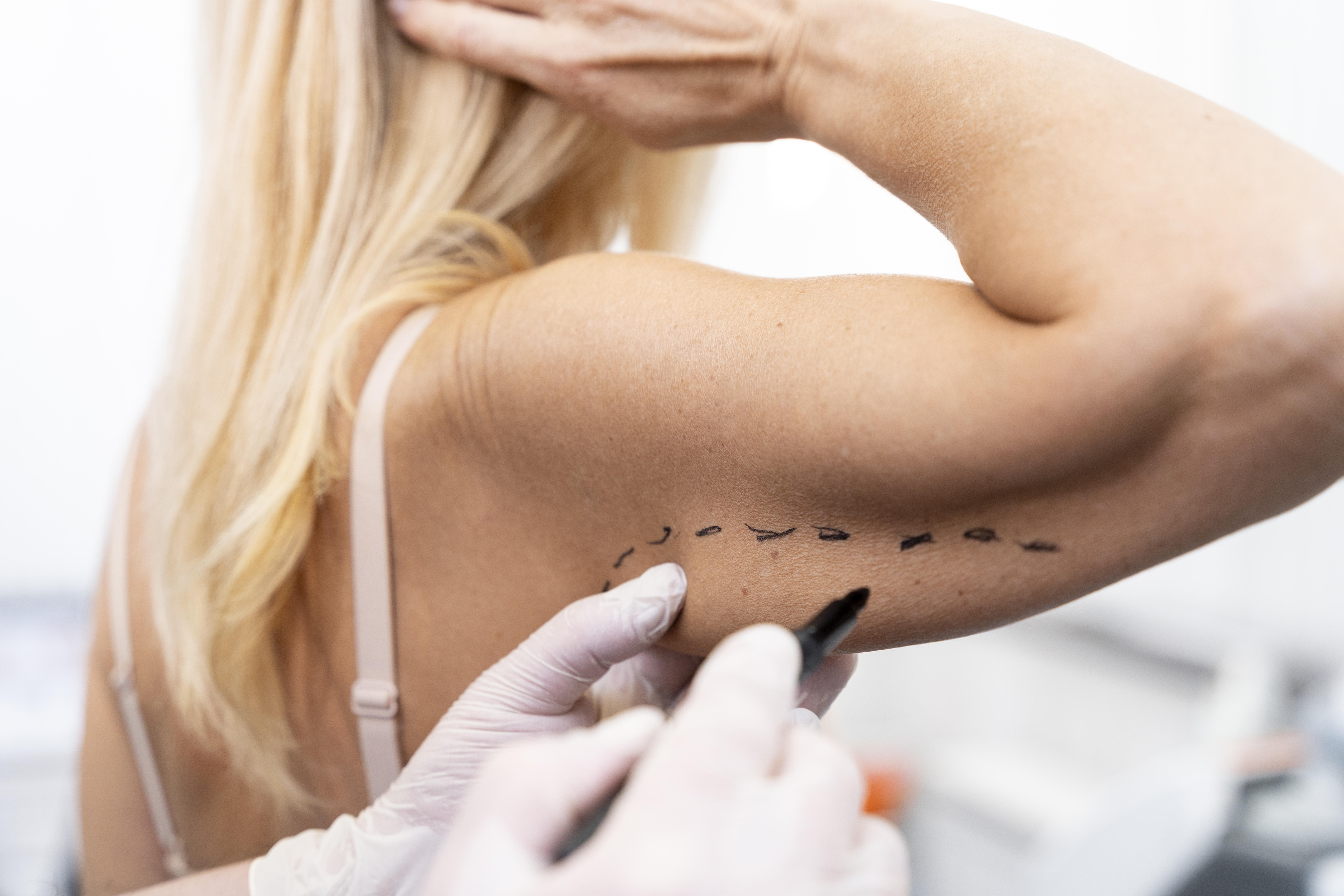  ترهّل الذراعين: أسبابه والعلاجات الأفضل والأنسب لحالتك